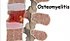 Osteomyelit
